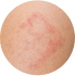 Skin Problem